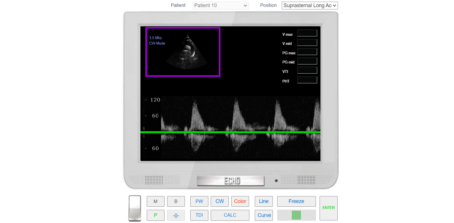 transmitral_flow_doppler