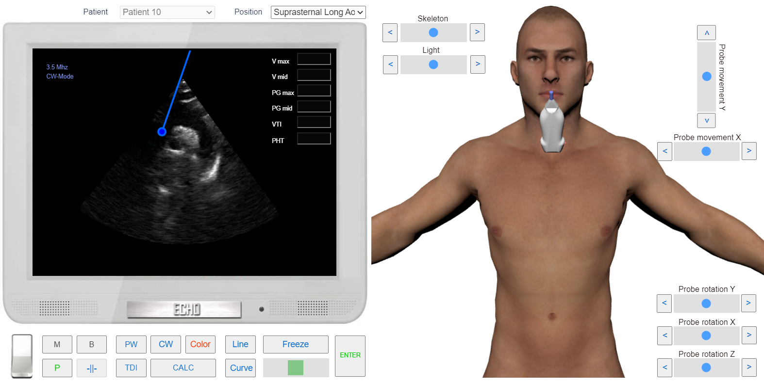 transmitral_flow_doppler