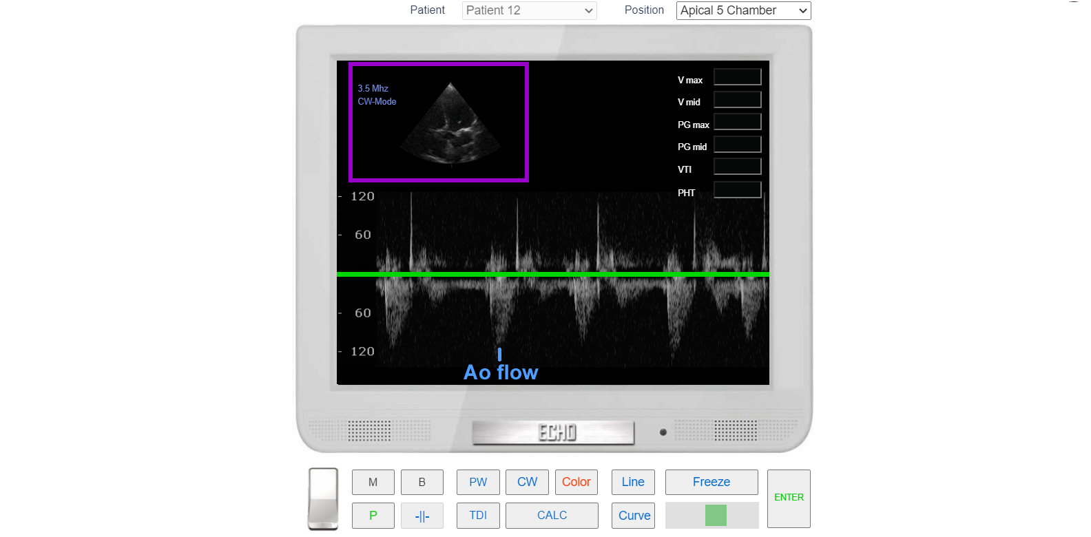 transmitral_flow_doppler