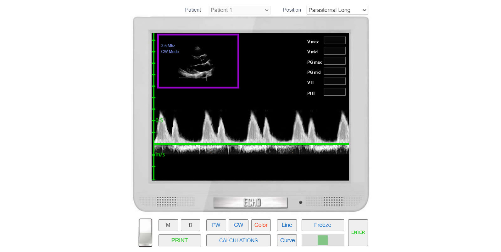 CW Doppler