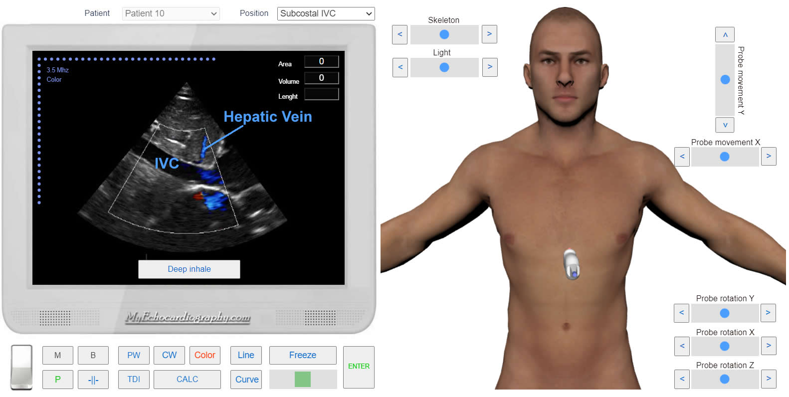 transmitral_flow_doppler