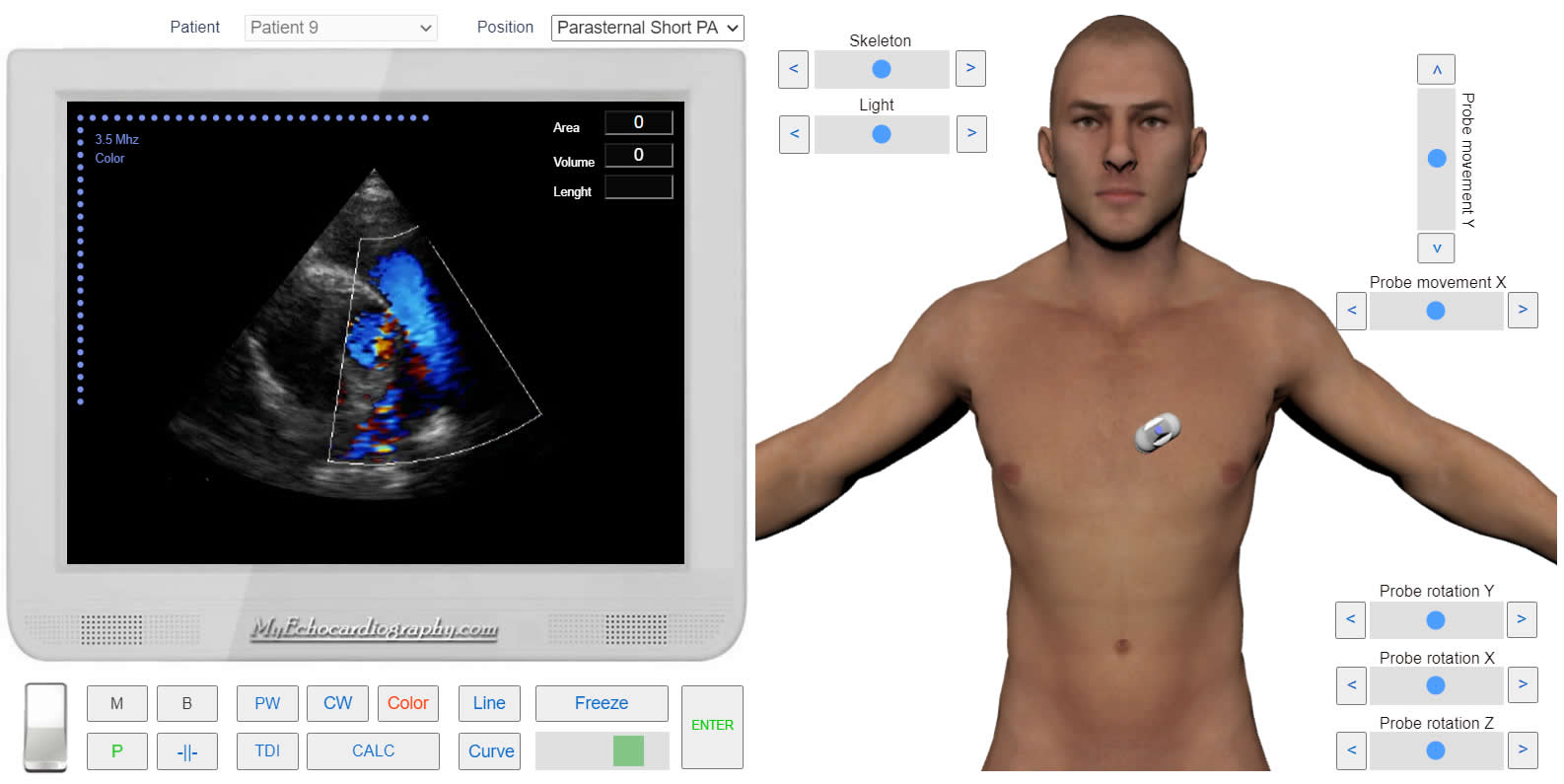 transmitral_flow_doppler