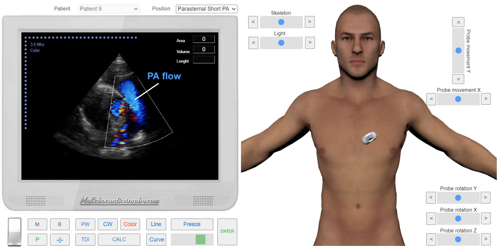 transmitral_flow_doppler