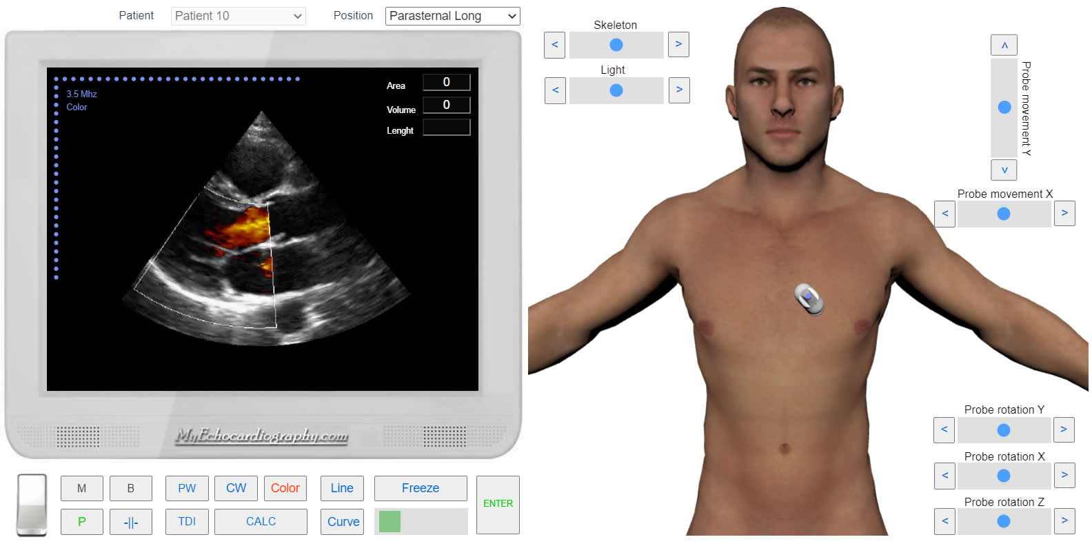 transmitral_flow_doppler