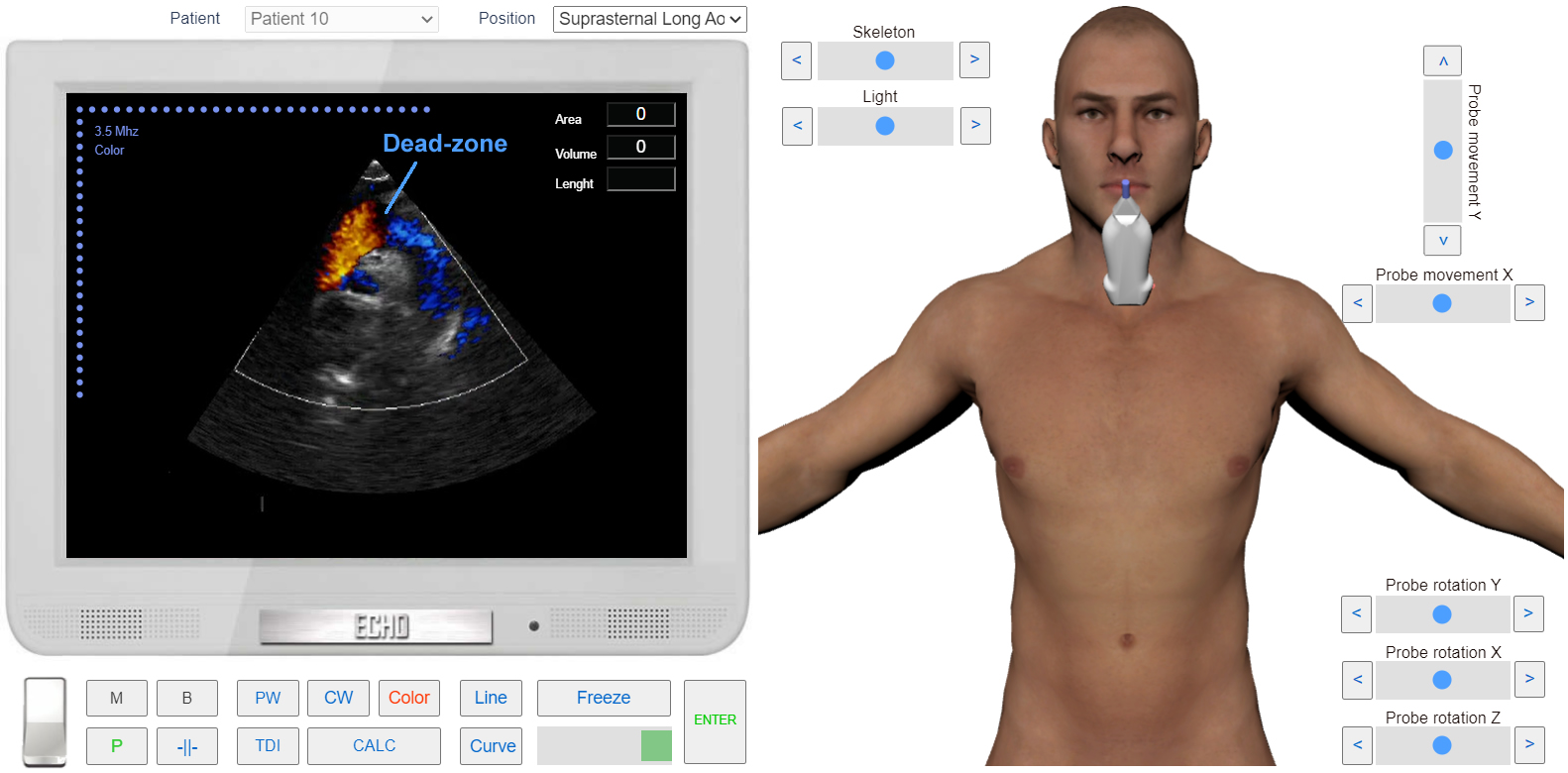 transmitral_flow_doppler