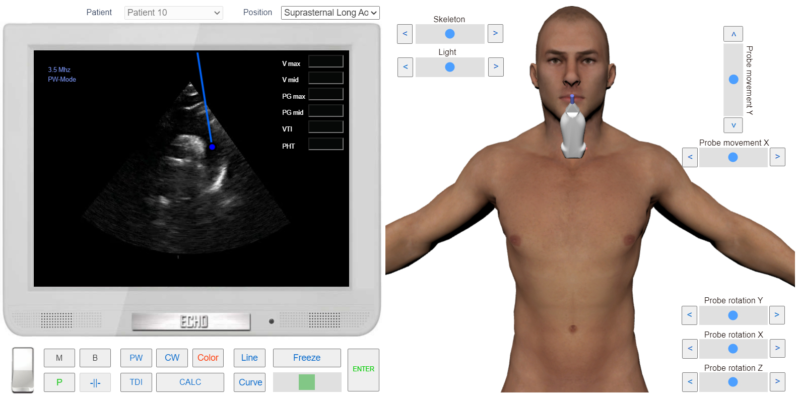transmitral_flow_doppler