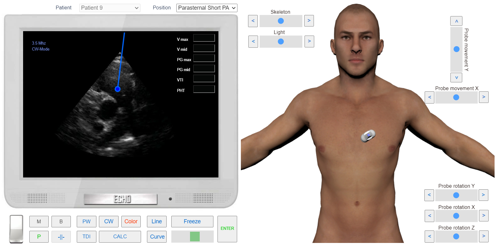 transmitral_flow_doppler