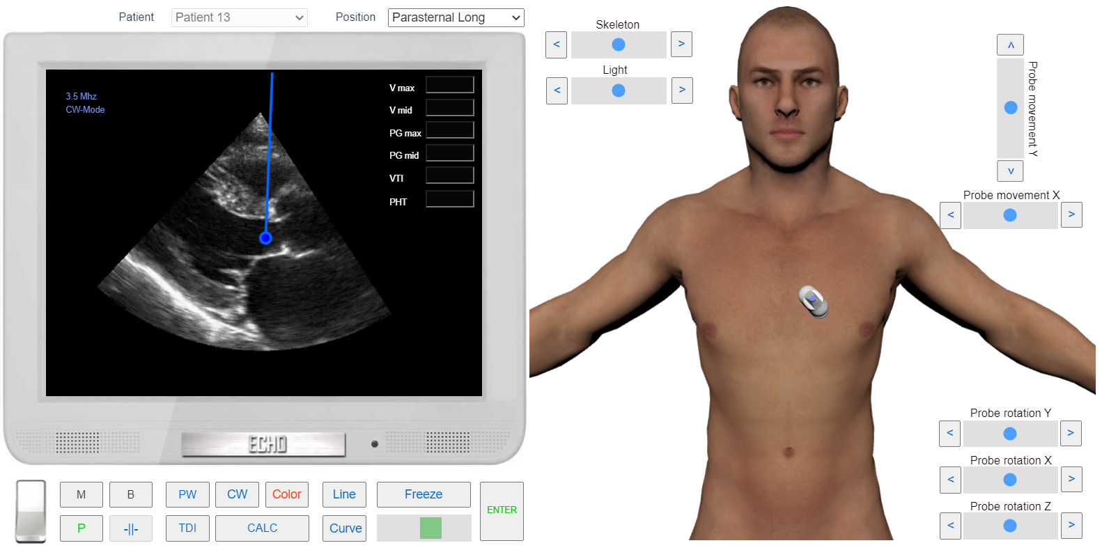 transmitral_flow_doppler