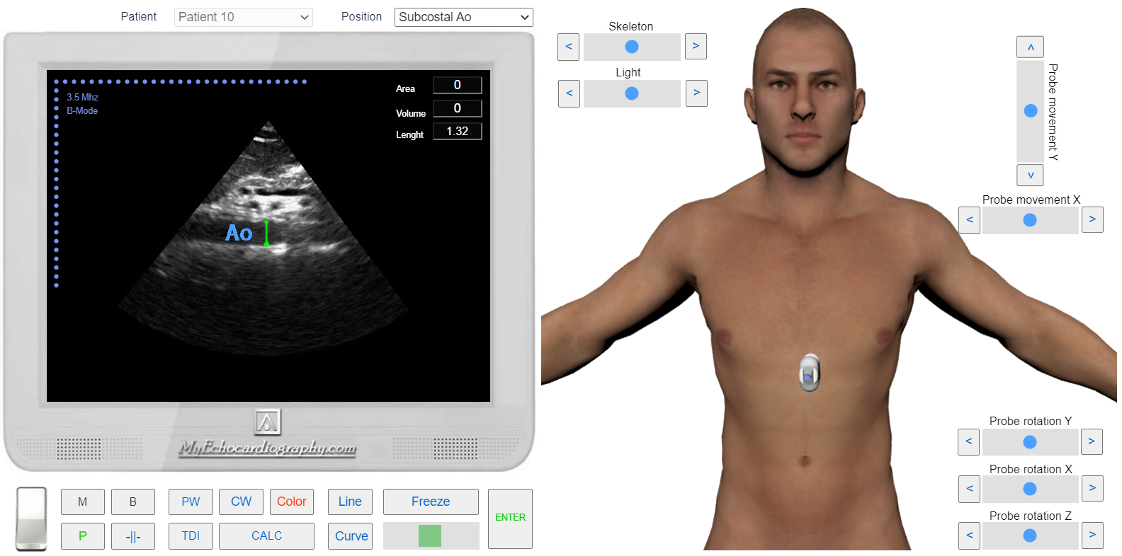 transmitral_flow_doppler