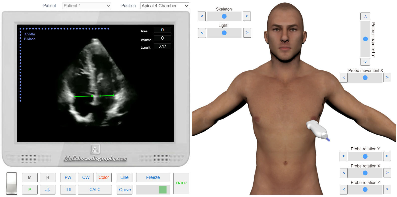 transmitral_flow_doppler