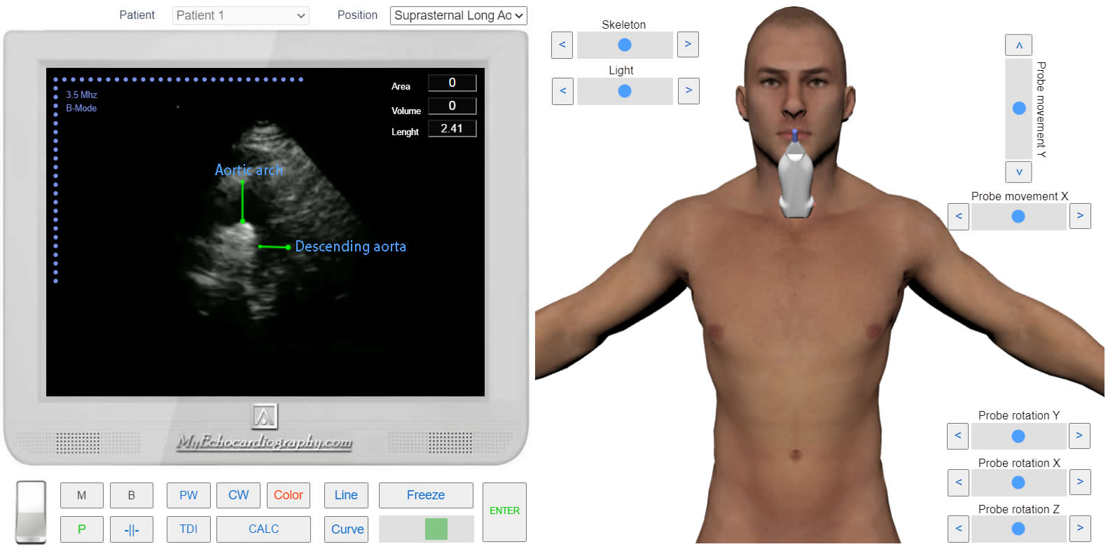 transmitral_flow_doppler