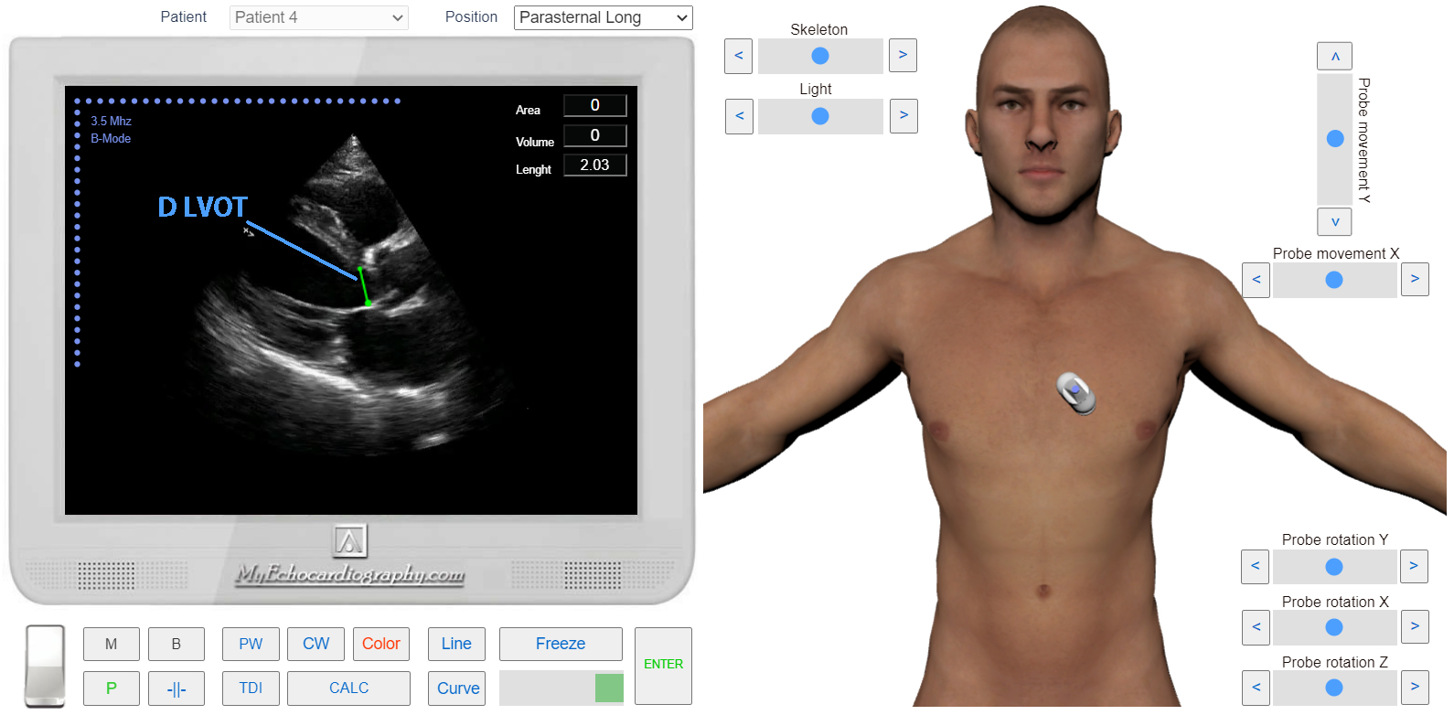 transmitral_flow_doppler