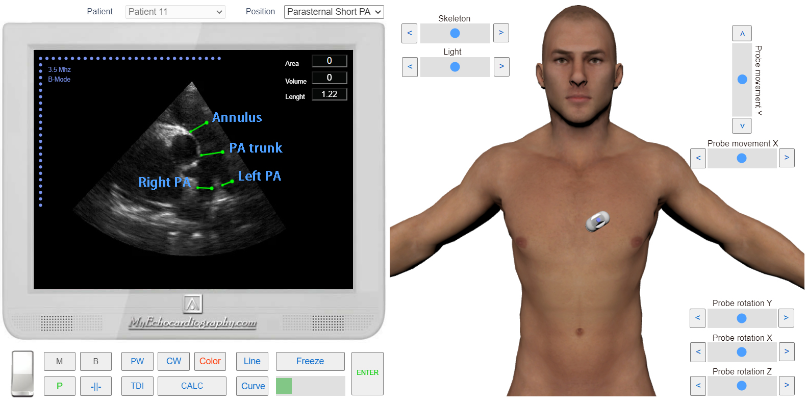 transmitral_flow_doppler