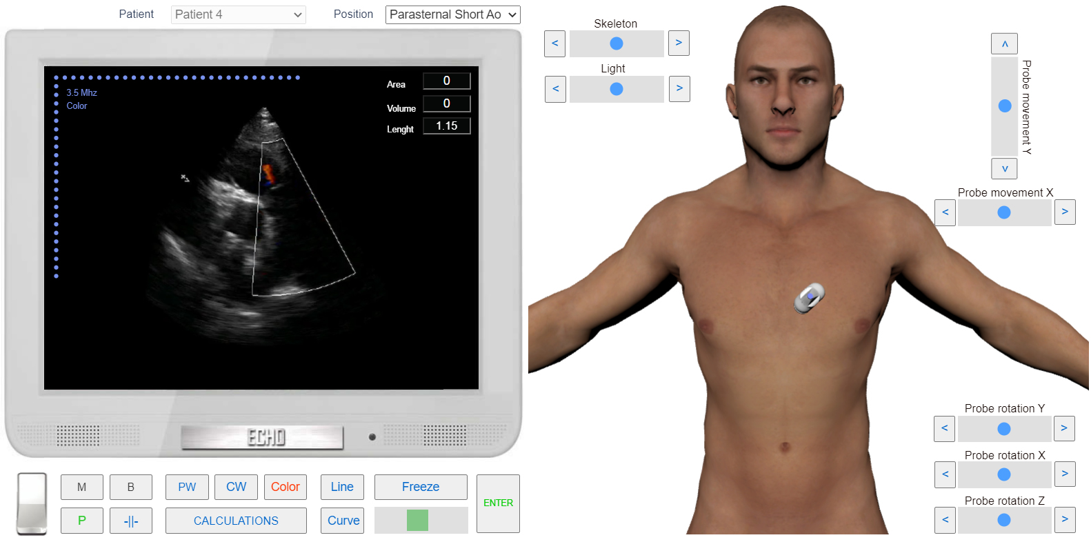 assessment of Pulmonary Regurgitation