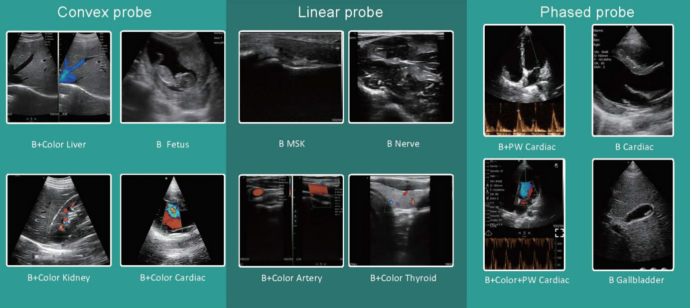 Diastolic_flow