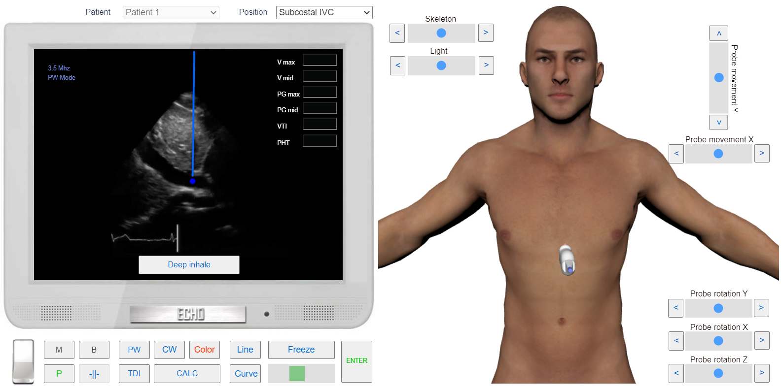 transmitral_flow_doppler