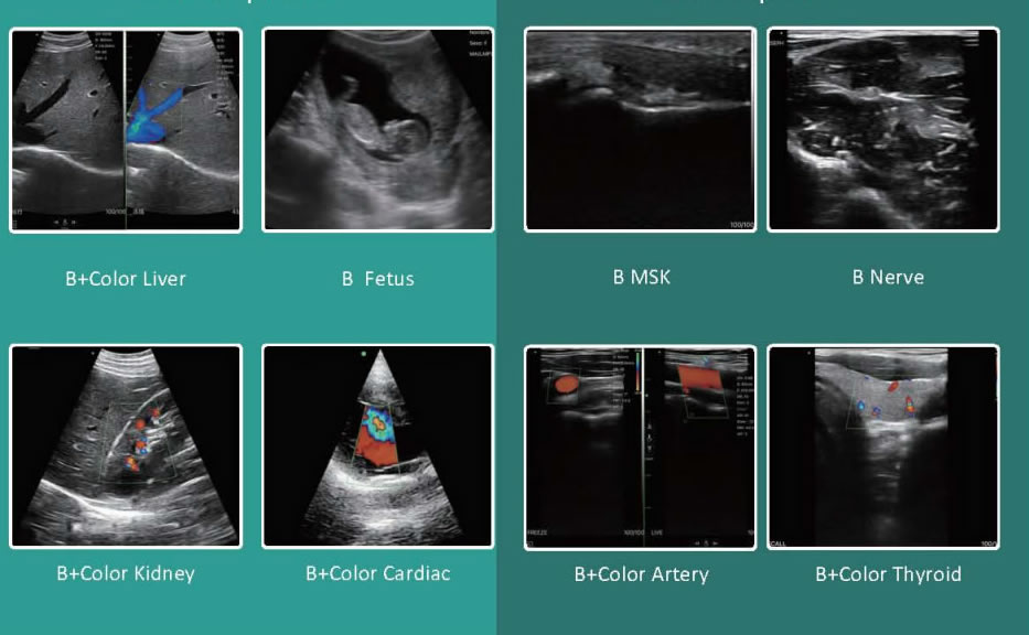 Diastolic_flow