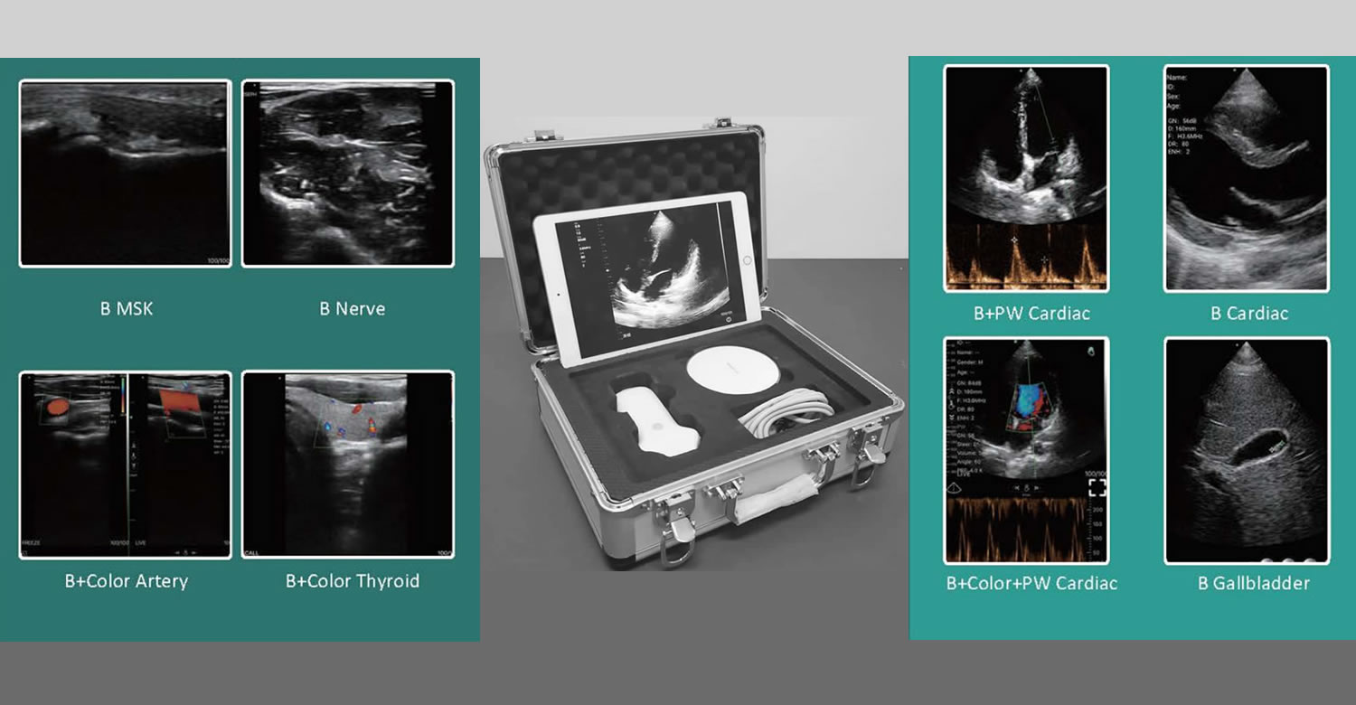 Diastolic_flow